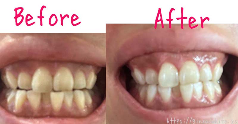 銀座デンタルホワイトでホワイトニング施術前後の歯の比較
